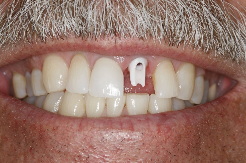 Can Dental Implant Crowns Look Natural? Konig DDS